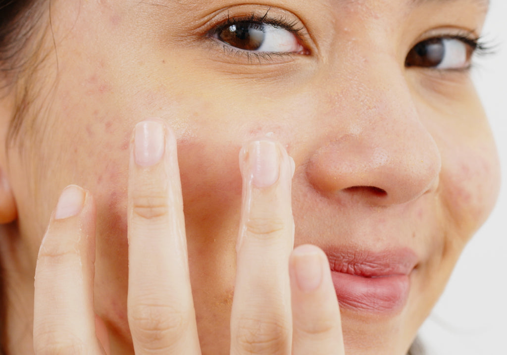 Do I Need To Moisturise If I Have Oily Or Combination Skin?