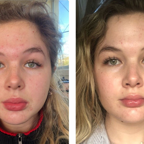 How Lucy Tackled Hormonal Acne