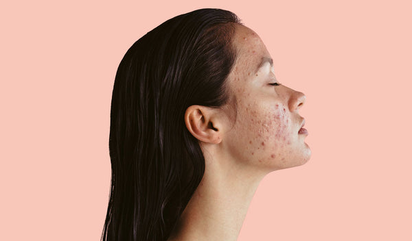 The Best Way To Treat Hyperpigmentation According To Dermatologists