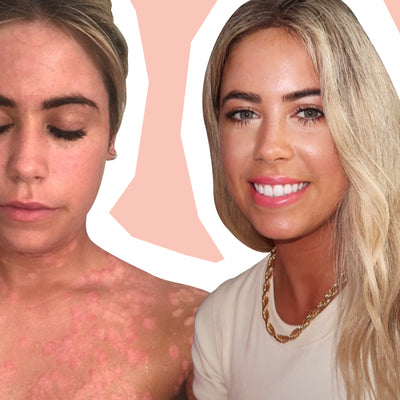 Psoriasis Isn’t Just A Skin Condition