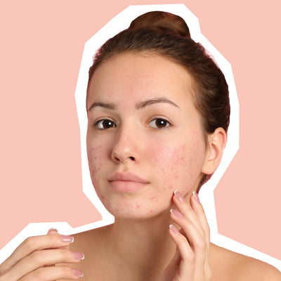 Acne Scarring, Explained