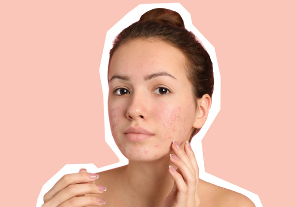 Acne Scarring, Explained